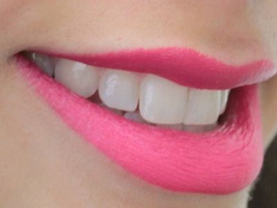 ortodoncia invisible viladecans invisalign clínica dental en viladecans